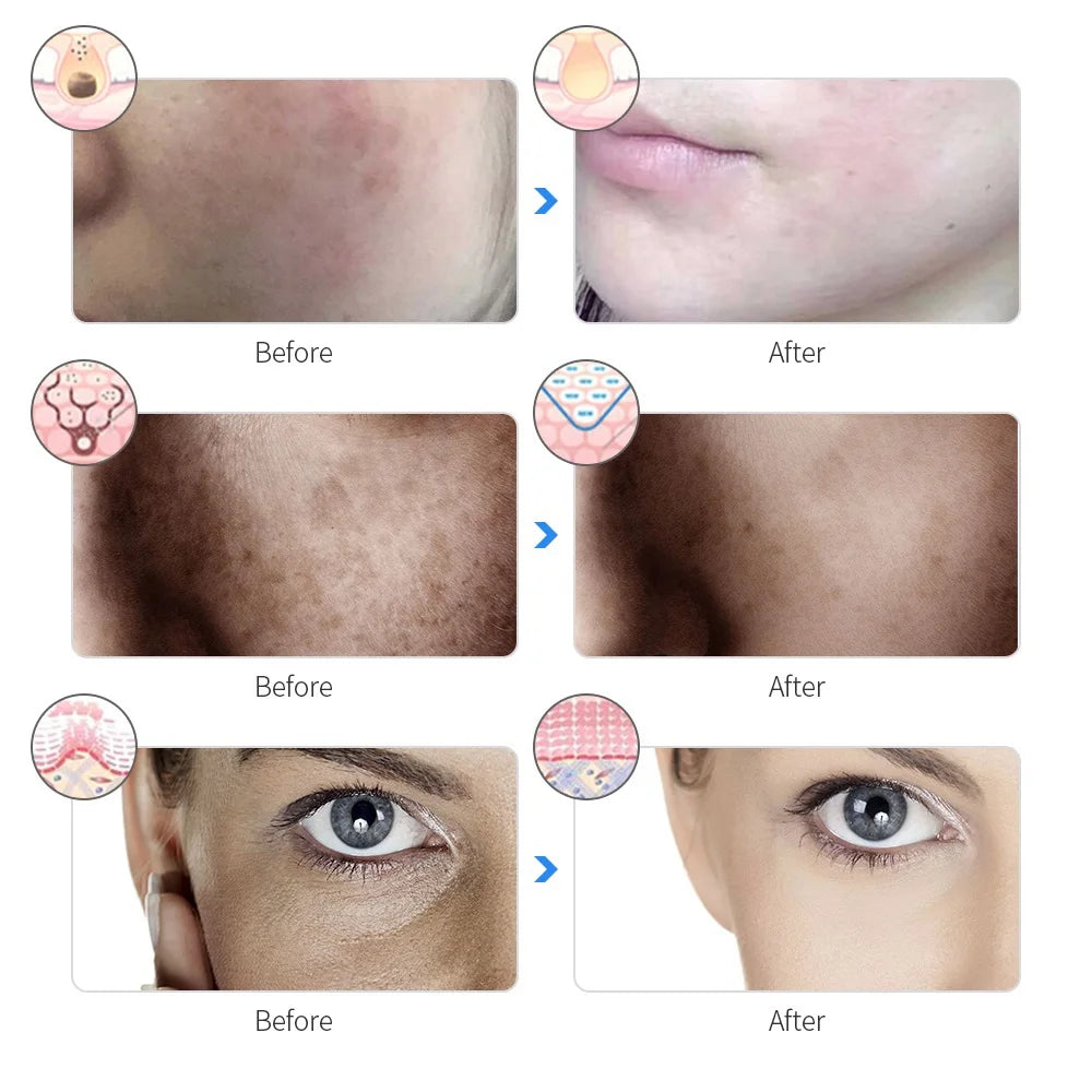 Facial LED Mask 7