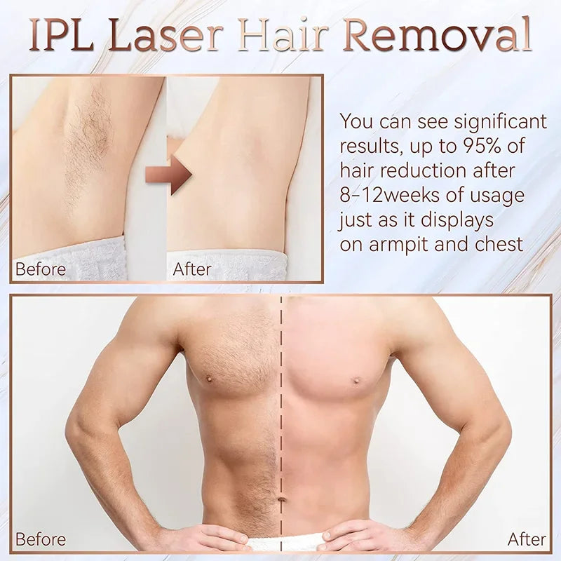 Laser Hair Removal Device